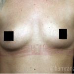 Breast Augmentation Before & After Patient #2118