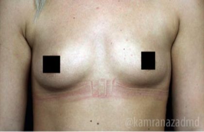 Breast Augmentation Before & After Patient #2118