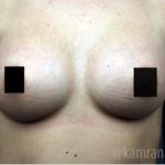 Breast Augmentation Before & After Patient #2118