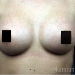Breast Augmentation Before & After Patient #2118