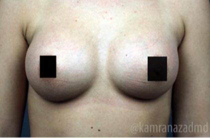 Breast Augmentation Before & After Patient #2118