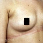 Breast Augmentation Before & After Patient #2118