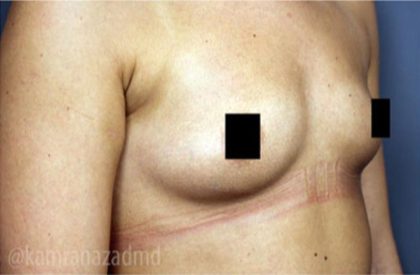 Breast Augmentation Before & After Patient #2118