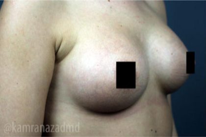 Breast Augmentation Before & After Patient #2118