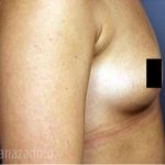 Breast Augmentation Before & After Patient #2118