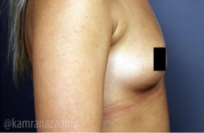 Breast Augmentation Before & After Patient #2118