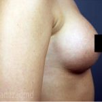 Breast Augmentation Before & After Patient #2118