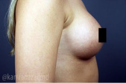 Breast Augmentation Before & After Patient #2118