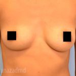 Breast Augmentation Before & After Patient #2146