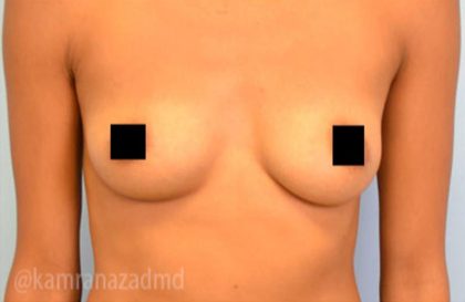 Breast Augmentation Before & After Patient #2146