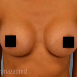 Breast Augmentation Before & After Patient #2146