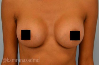 Breast Augmentation Before & After Patient #2146