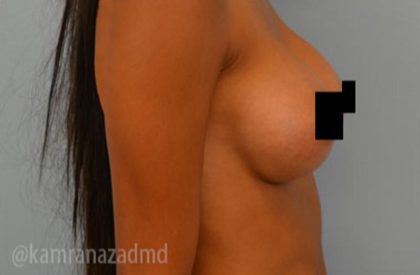 Breast Augmentation Before & After Patient #2146