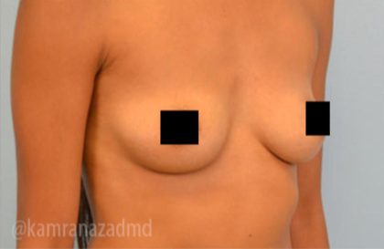 Breast Augmentation Before & After Patient #2146