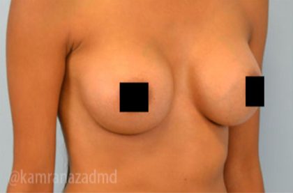 Breast Augmentation Before & After Patient #2146