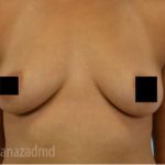 Breast Augmentation Before & After Patient #2147