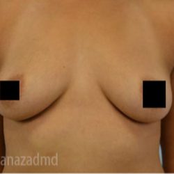 Breast Augmentation Before & After Patient #2147