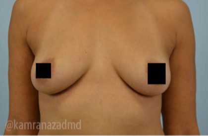 Breast Augmentation Before & After Patient #2147