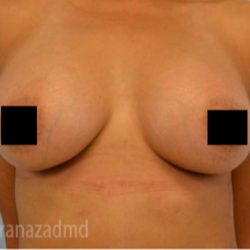 Breast Augmentation Before & After Patient #2147