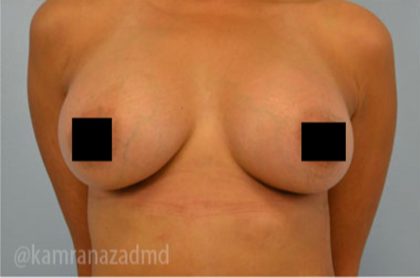 Breast Augmentation Before & After Patient #2147