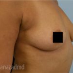 Breast Augmentation Before & After Patient #2147