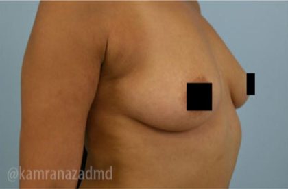 Breast Augmentation Before & After Patient #2147
