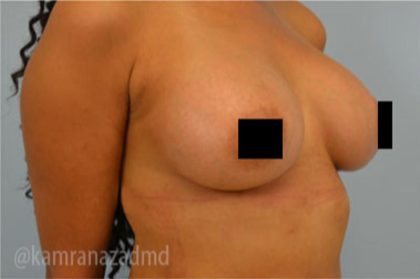Breast Augmentation Before & After Patient #2147
