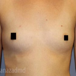 Breast Augmentation Before & After Patient #2148