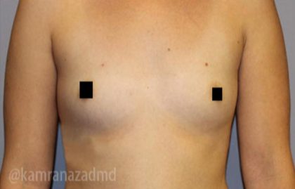 Breast Augmentation Before & After Patient #2148