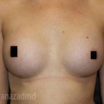 Breast Augmentation Before & After Patient #2148
