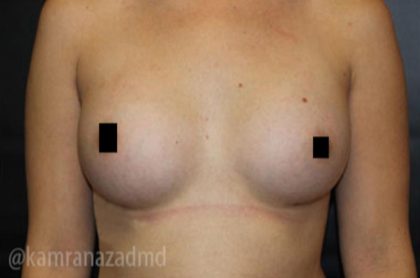 Breast Augmentation Before & After Patient #2148