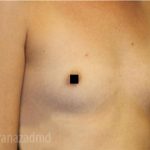 Breast Augmentation Before & After Patient #2148