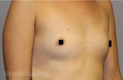 Breast Augmentation Before & After Patient #2148
