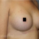 Breast Augmentation Before & After Patient #2148