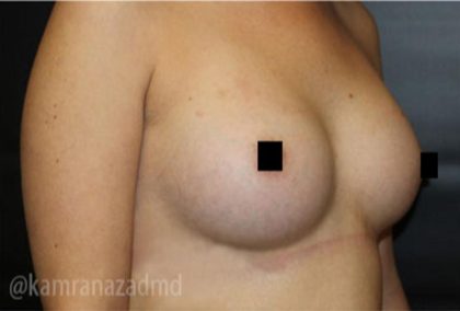 Breast Augmentation Before & After Patient #2148