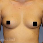 Breast Augmentation Before & After Patient #2149