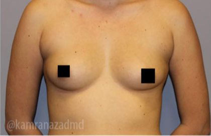 Breast Augmentation Before & After Patient #2149