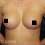 Breast Augmentation Before & After Patient #2149