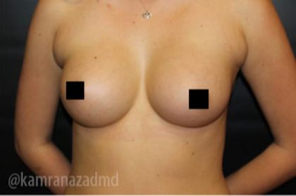 Breast Augmentation Before & After Patient #2149