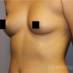 Breast Augmentation Before & After Patient #2149