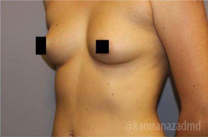 Breast Augmentation Before & After Patient #2149