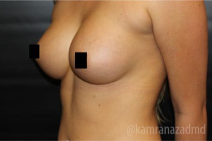 Breast Augmentation Before & After Patient #2149