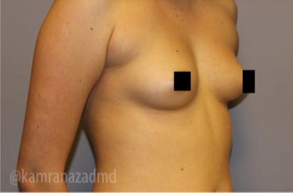Breast Augmentation Before & After Patient #2149