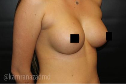 Breast Augmentation Before & After Patient #2149