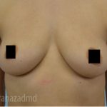 Breast Augmentation Before & After Patient #2150