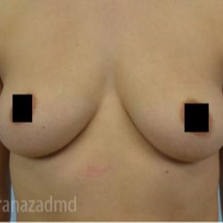 Breast Augmentation Before & After Patient #2150