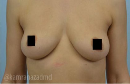 Breast Augmentation Before & After Patient #2150