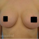 Breast Augmentation Before & After Patient #2150