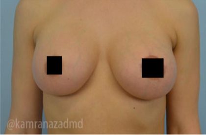 Breast Augmentation Before & After Patient #2150