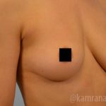 Breast Augmentation Before & After Patient #2150